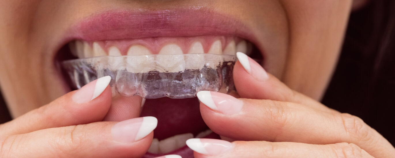 invisalign tatuapé